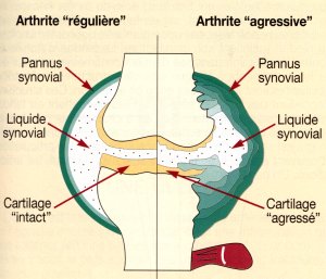 arthrite